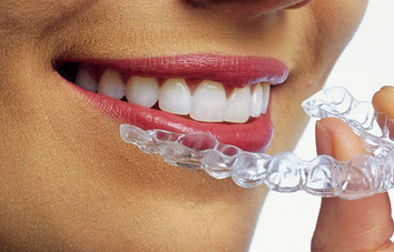 32 Smile Stone Clear Aligners